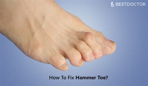 How To Fix Hammer Toe Pinky Toe Repair Fix Your Pinky Toes Youtube
