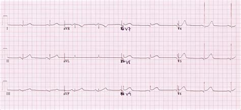 Posterior Myocardial Infarction Case Study Parramatta