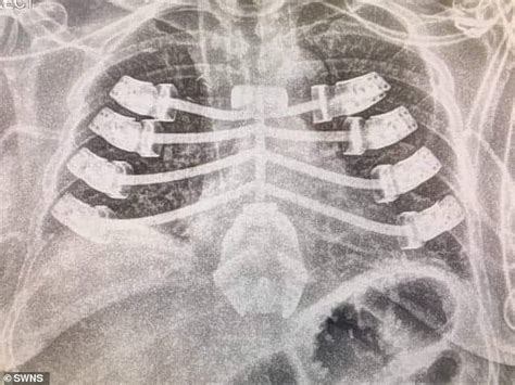 Uk Patient Becomes Sixth Person In The World Fitted With 3d Printed Rib