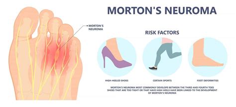 Mortons Neuroma Diagnosis Symptoms And Treatment