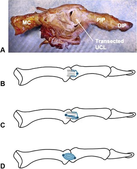 Biomechanical Comparison Of Thumb Ulnar Collateral Ligament Repair