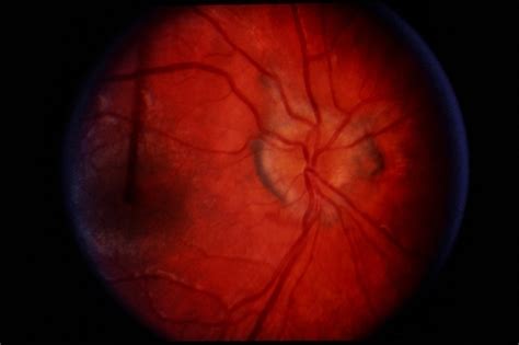Peripapillary Cnvm Uveitis Retina Image Bank