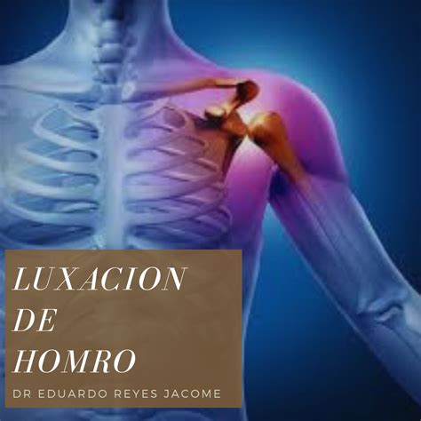 LuxaciÓn De Hombro Cirugia De Columna En Matamoros