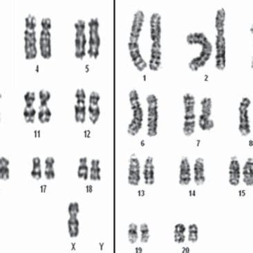 Pdf X Xxx Xx Karyotype In A Female With Turners Syndrome