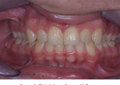 Figure 8 From Autotransplantation Of Two Immature Third Molars With The