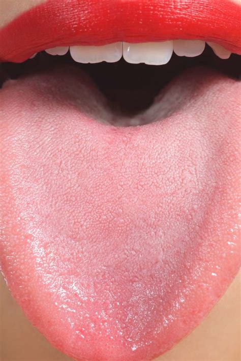 Hpv Bumps On Back Of Tongue Mouth Wart Stock Image C046 1001 Science