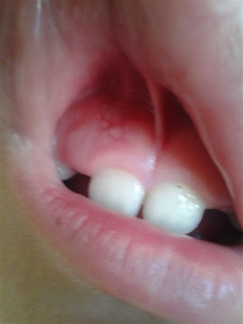 White Spots On Tongue And Swollen Gums Naturally