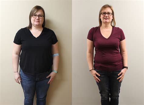 Bonnies Gastric Sleeve Before And After St Louis Bariatrics