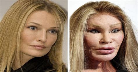 These Hollywood Celebrities Suffered Lifetime Embarrassment Due To Failed Plastic Surgery Bad