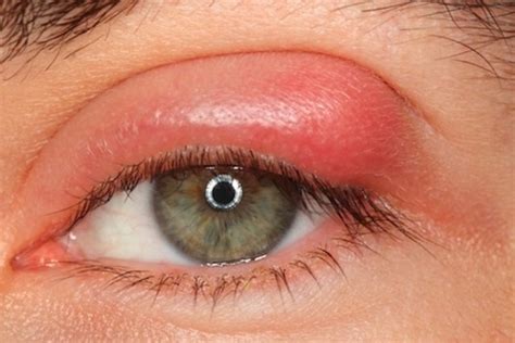 Bolita en el ojo causas y qué hacer Tua Saúde