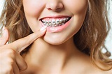 3 Reasons to Get Adult Braces | Texas Orthodontists