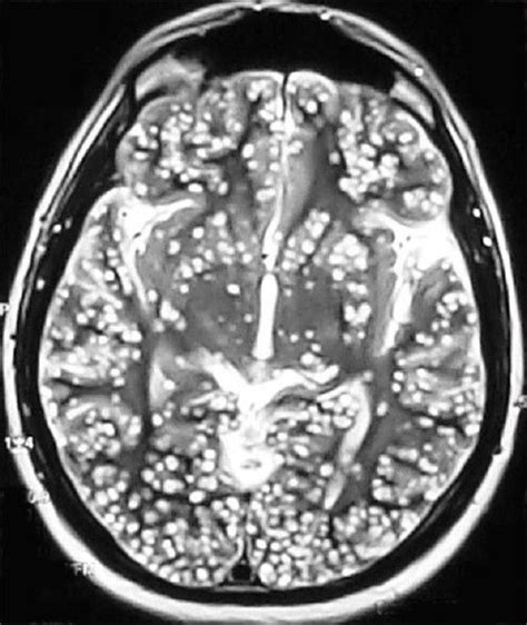 Magnetic Resonance Image Mri Of The Brain Showing Numerous White Dots
