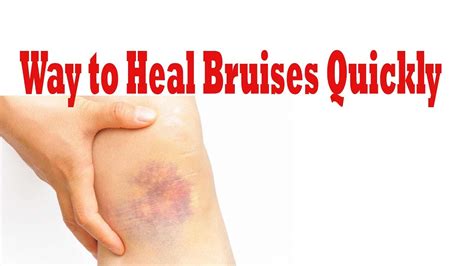 How To Get Rid Of Bruises Way To Heal Bruises Quickly How To