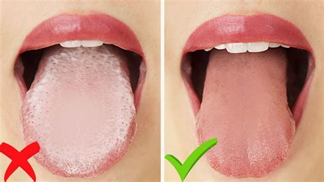 Here Are Things To Consider If You Have A White Tongue