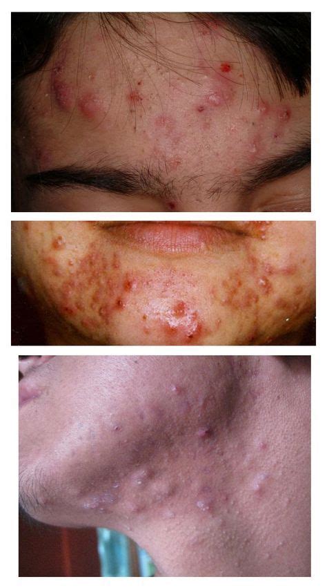 How To Recognize What Kind Of Acne You Have Innate Skin Types Of