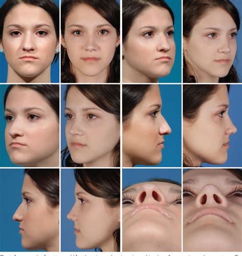 Figure From Decreasing Nasal Tip Projection In Rhinoplasty Special
