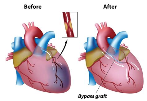 Coronary Artery Bypass Graft Surgery Cabg Cardiovascular