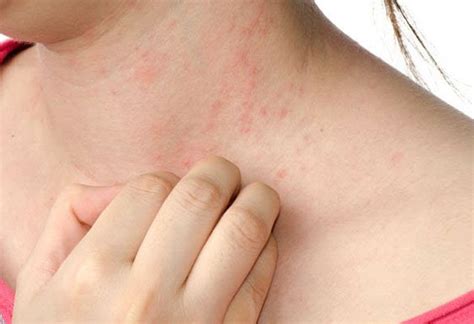 An Inflammatory Chronic Skin Disorder Eczema Affects More Than 15