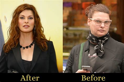 Linda Evangelista Before And After Surgery And What Is Linda