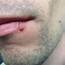 Ive Had A Scab On My Lip For Couple Of Weeks Any Ideas What It 