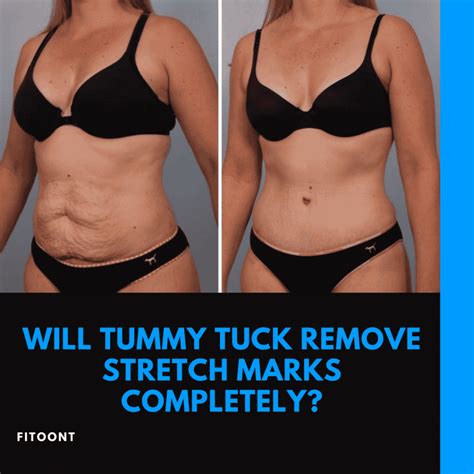 Will A Tummy Tuck Remove Stretch Marks Completely Fitoont