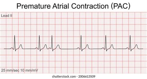 Electrocardiogram Show Premature Atrial Contraction Pac