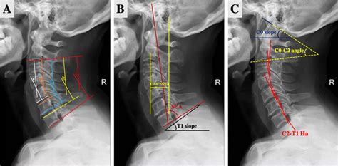 Radiographic Evaluation Of Sagittal Alignment Of Cervical Spine Aa