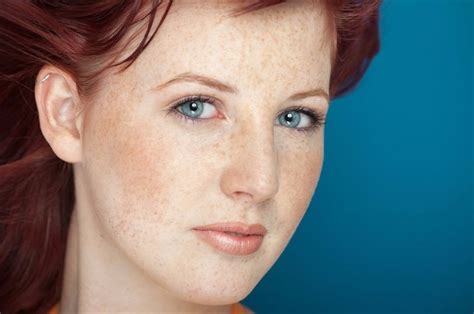Exploring The Truth Behind Developed Freckles Causes And Health