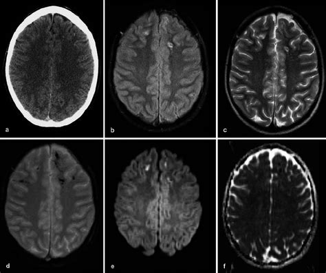 Diffuse Axonal Injuries In A 14 Year Old Boy 4 Days After A Motor