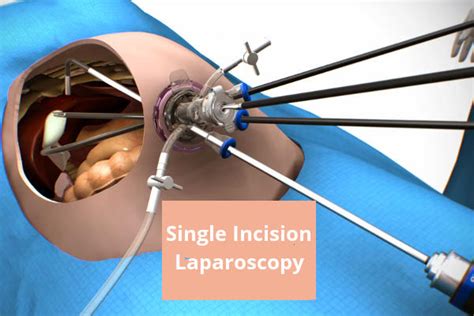 Λαπαροσκόπηση μίας τομής single incision laparoscopy