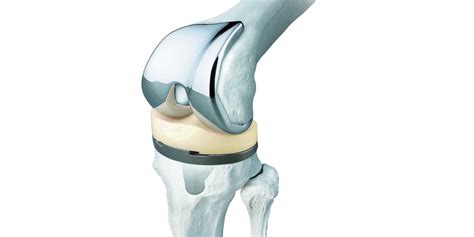 Best Orthopaedic Implants For Your Joint Needs Orthopedics Implants