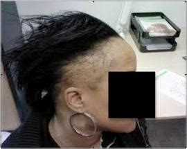 He has a vast amount of training with hair restoration. Los Angeles Traction Alopecia