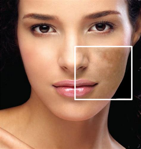 Melasma 101 Everything You Need To Know About The Common Skin