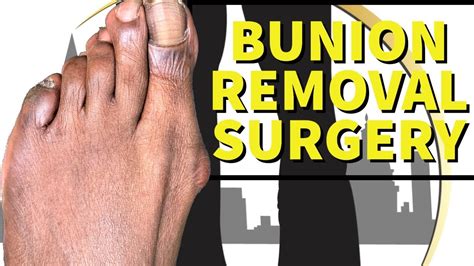 Bunionectomy Surgical Bunion Removal Bloodless 4k Youtube