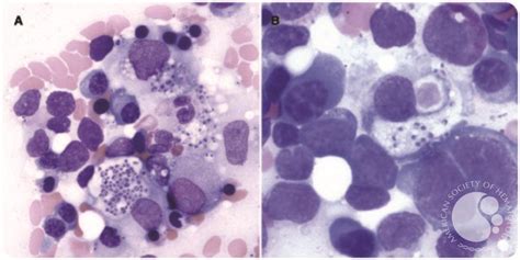 Hemophagocytic Lymphohistiocytosis And Disseminated Histoplasmosis
