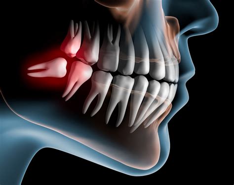 Pulling Wisdom Teeth Can Improve Long Term Taste Function Penn Today