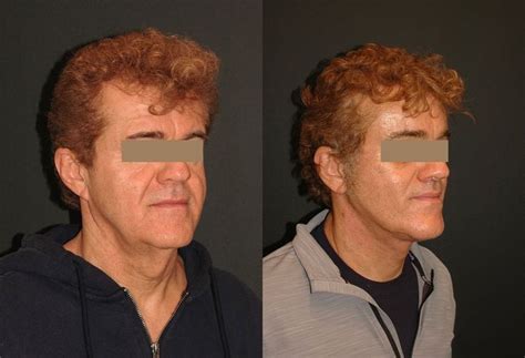 Male Facelift Patient Of Dr Andrew Jacono Showing A Before And After
