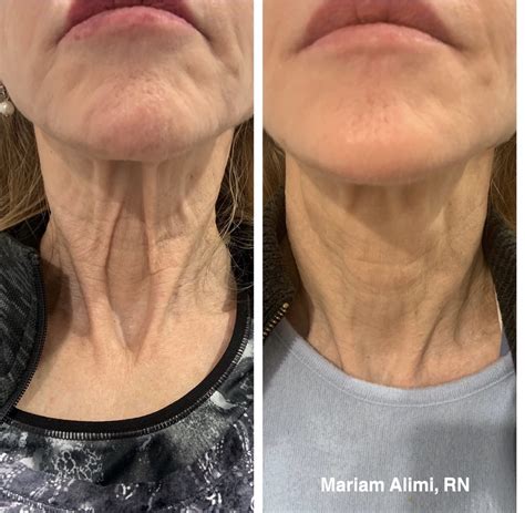 Dermapen Micro Needling Before And After Hot Sex Picture