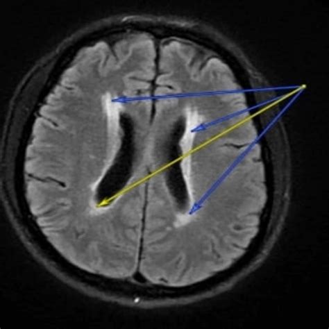 Mri Brain White Spots Cause Mri Scan Images Mri Brain Mri Scan Images