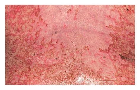 A Confluent Maculopapular Exanthema And Bullae And Skin Erosions Of