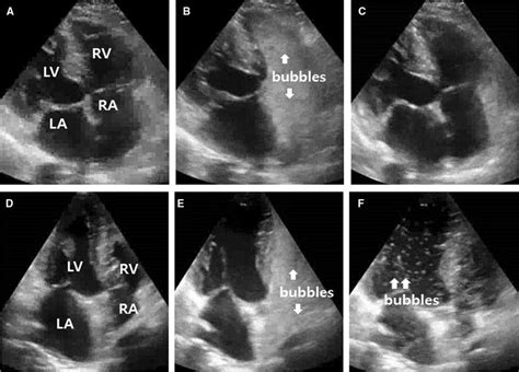 Representative Saline Agitated Contrast Enhanced Echocardiography Of