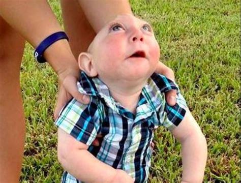This Brainless Baby Defied Odds By Reaching His First Birthday