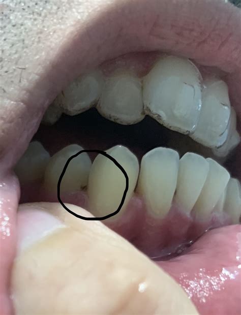 Dark Spot On Front Tooth Near Gum Line Rinvisalign
