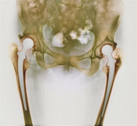 Double Hip Replacement X Ray Photograph By