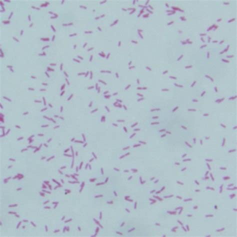 Gram Stained Smear Of Peritoneal Dialysate Showing Scattered