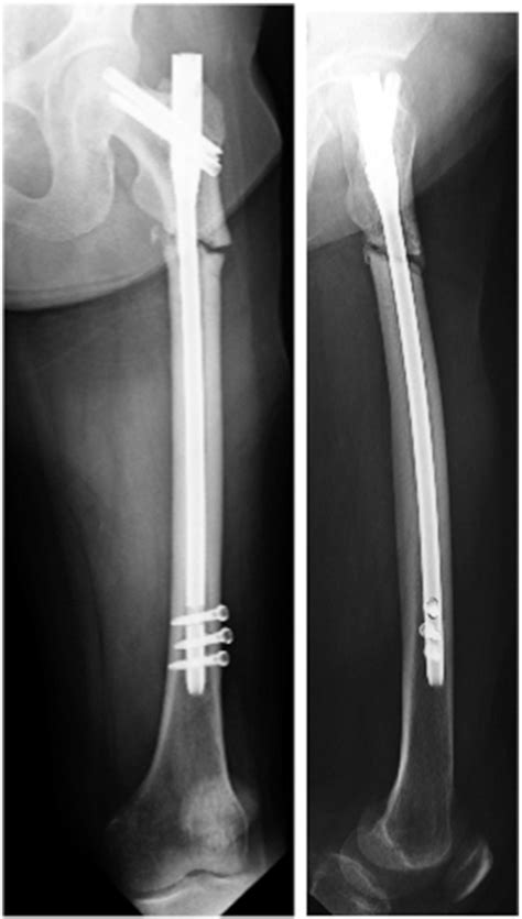 Ap And Lateral X Ray Of The Left Femur Just Before The Second Operation