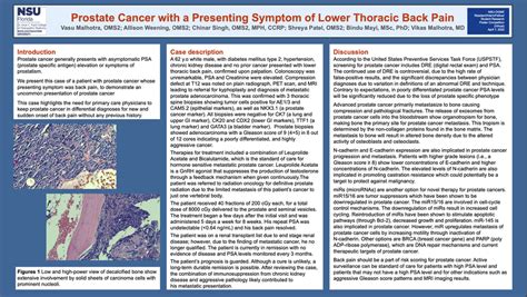 Prostate Cancer With A Presenting Symptom Of Lower Thoracic Back Pain