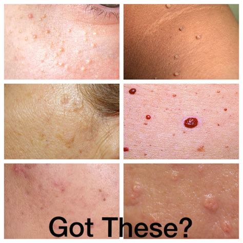 Skin Classic Treatments Lighten Up Laser