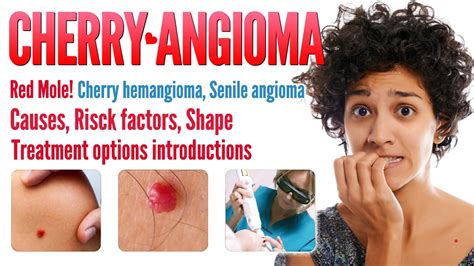 Cherry Angioma Causes Shapes And Treatment Options Red Mole Cherry Hemangioma Mole