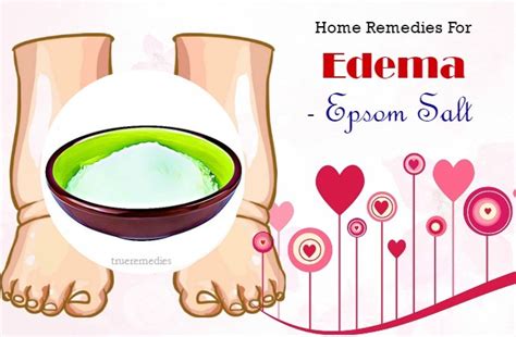 17 Home Remedies For Edema In Hands Legs Ankles And Feet